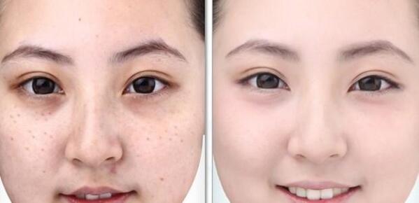 tác dụng của cấy hồng sâm lên mặt