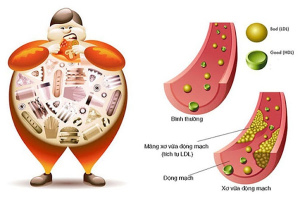 Những biểu hiện của bệnh rối loạn mỡ máu gây ảnh hưởng đến sức khỏe