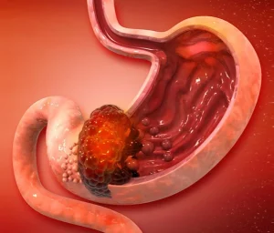 ung thư dạ dày có nguy hiểm không