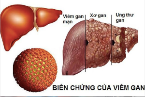 biến chứng viêm gan