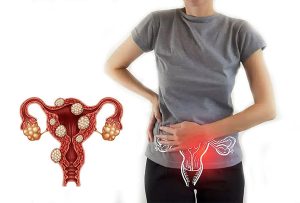 u xơ tử cung là gì